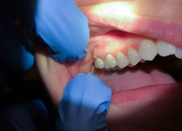 Best Emergency Gum Treatment in Mount Pleasant, IA
